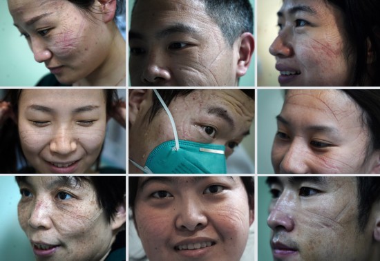 這是2月6日拍攝的南昌大學第一附屬醫院象湖院區隔離病房重症監護室醫護人員臉上被護目鏡和口罩壓出的印痕（拼版照片）。新華社記者 萬象 攝